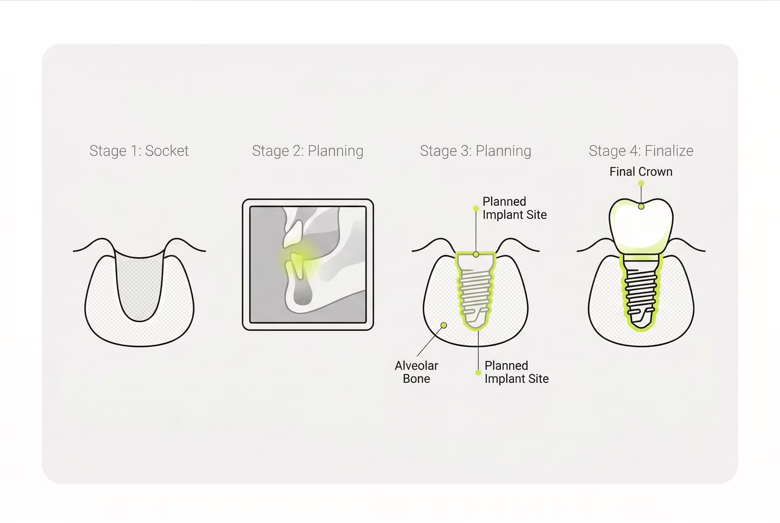 Схема диагностики и планирования импланта после удаления