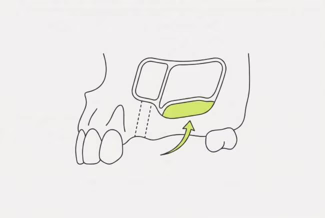 Синус-лифтинг перед имплантацией в Москве: гайд 2026