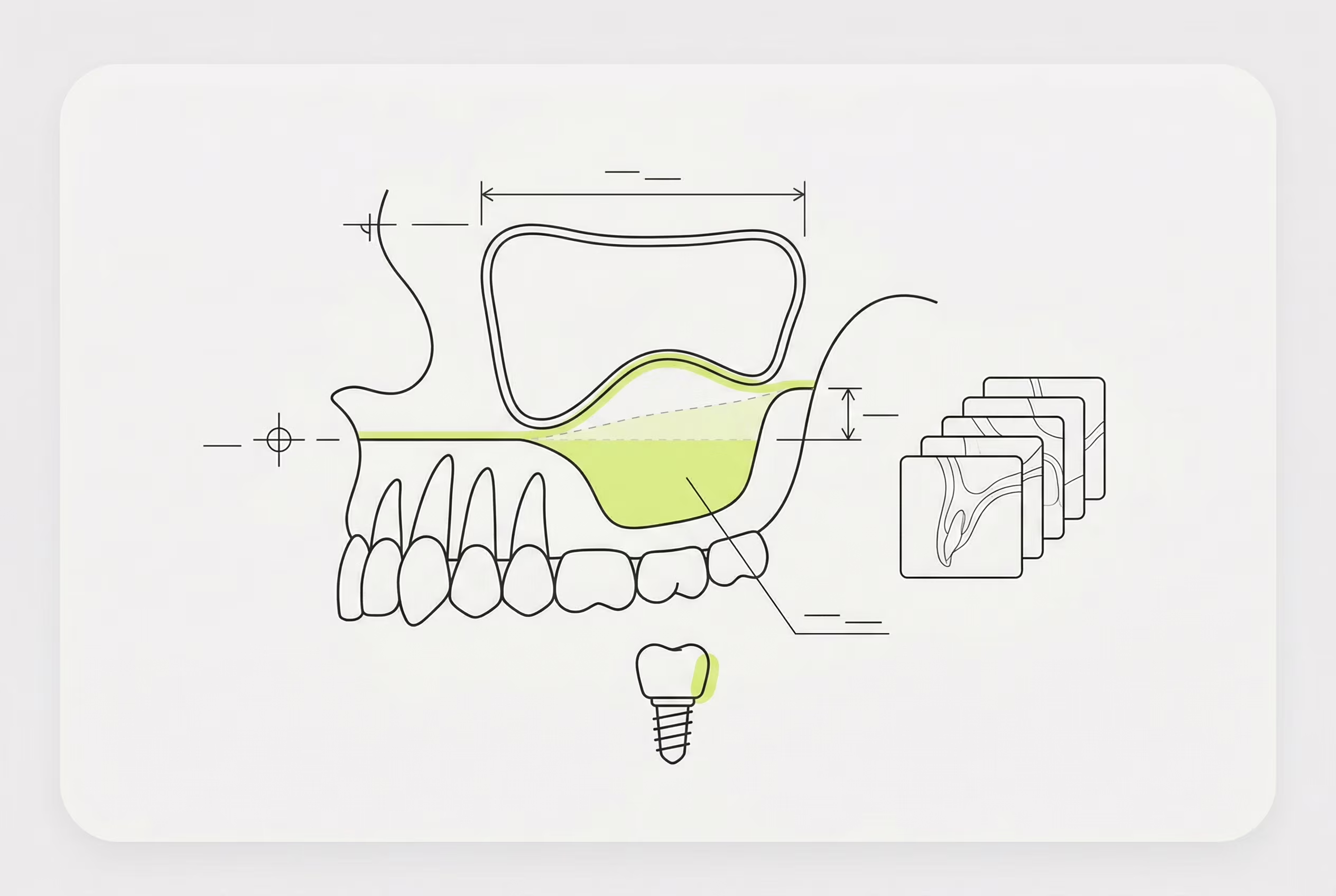 Схема КТ перед синус-лифтингом
