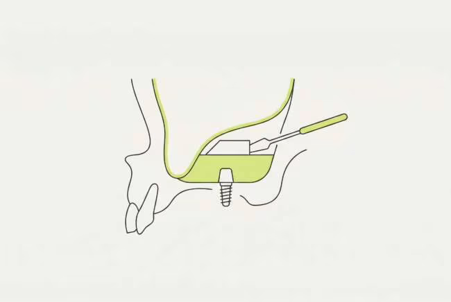 Синус-лифтинг перед имплантацией в Москве: гайд 2026