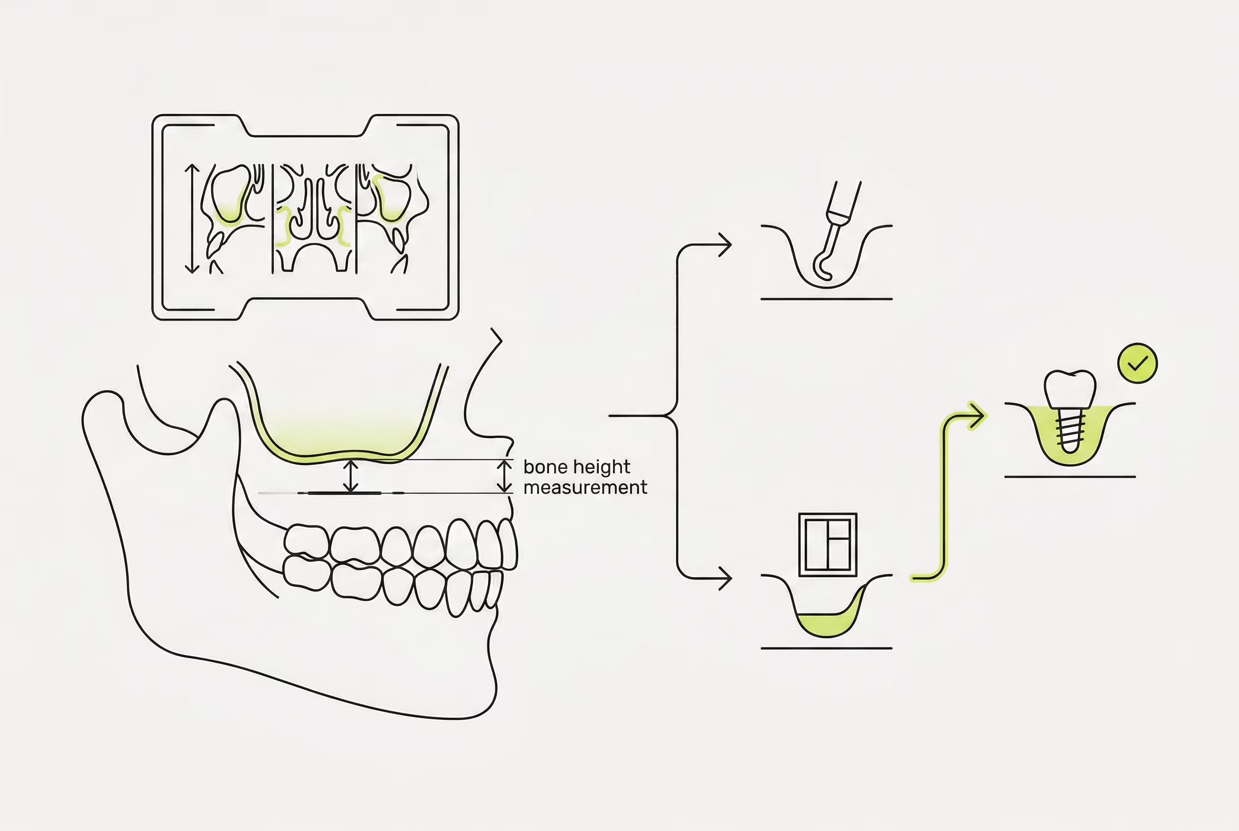 Схема КТ и выбора метода синус-лифтинга