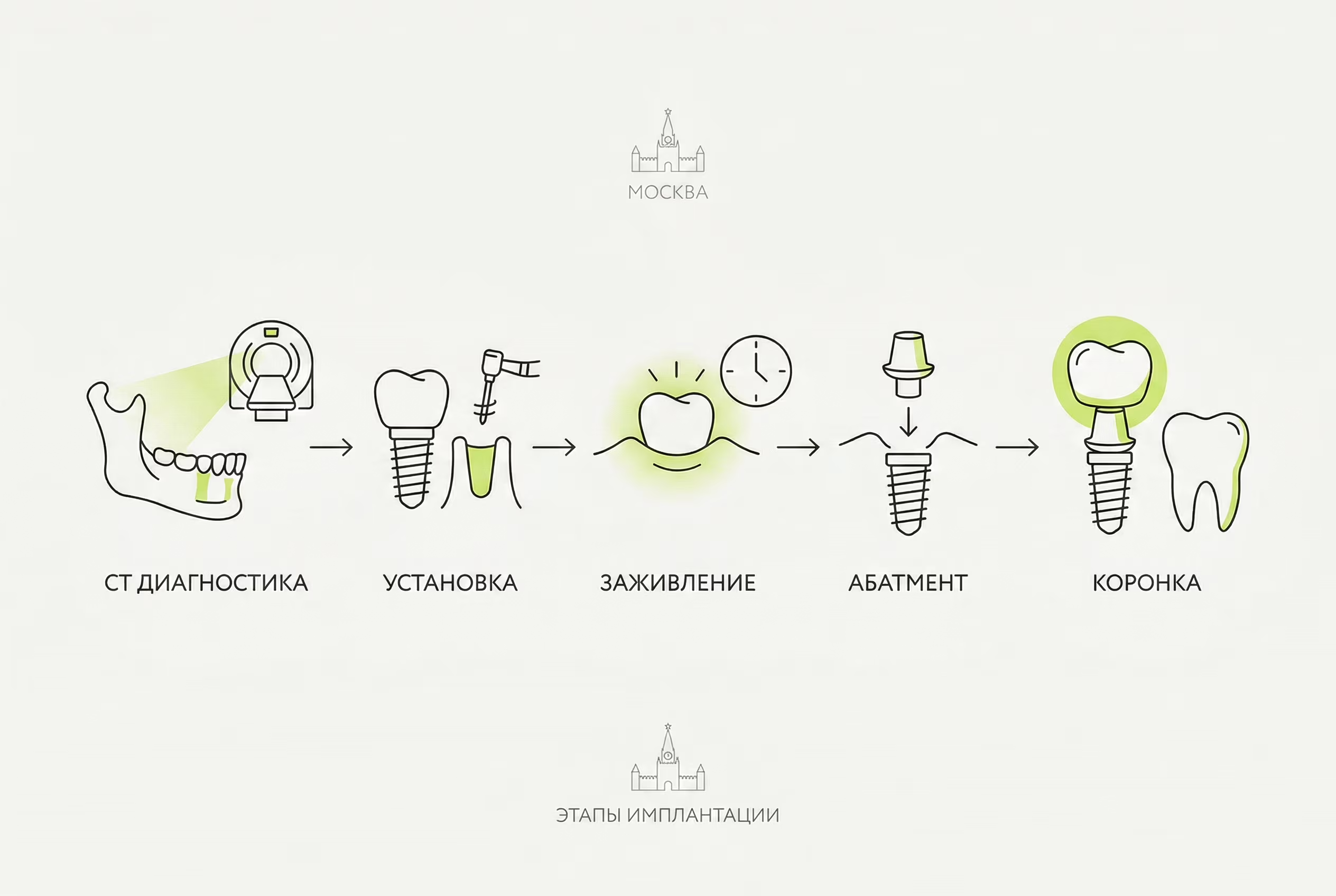 Схема этапов установки одного импланта