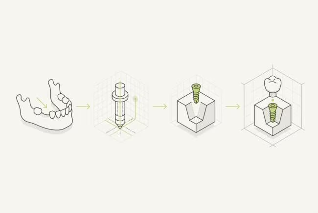 Как проходит имплантация зубов: этапы и сроки