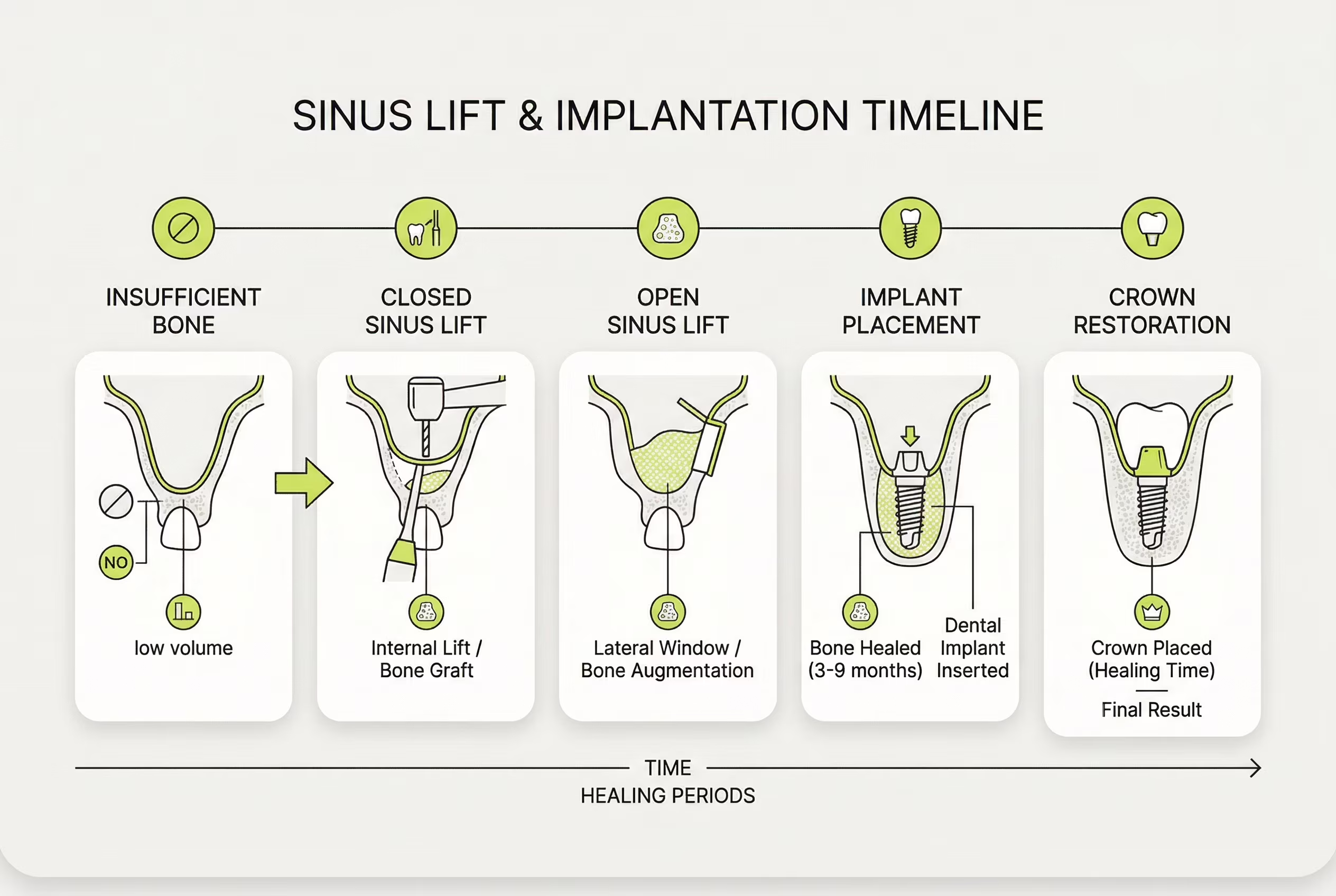 Схема сроков синус-лифтинга и имплантации